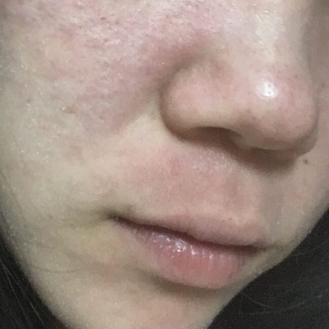 アトピー性皮膚炎で顔に炎症を起こしている写真