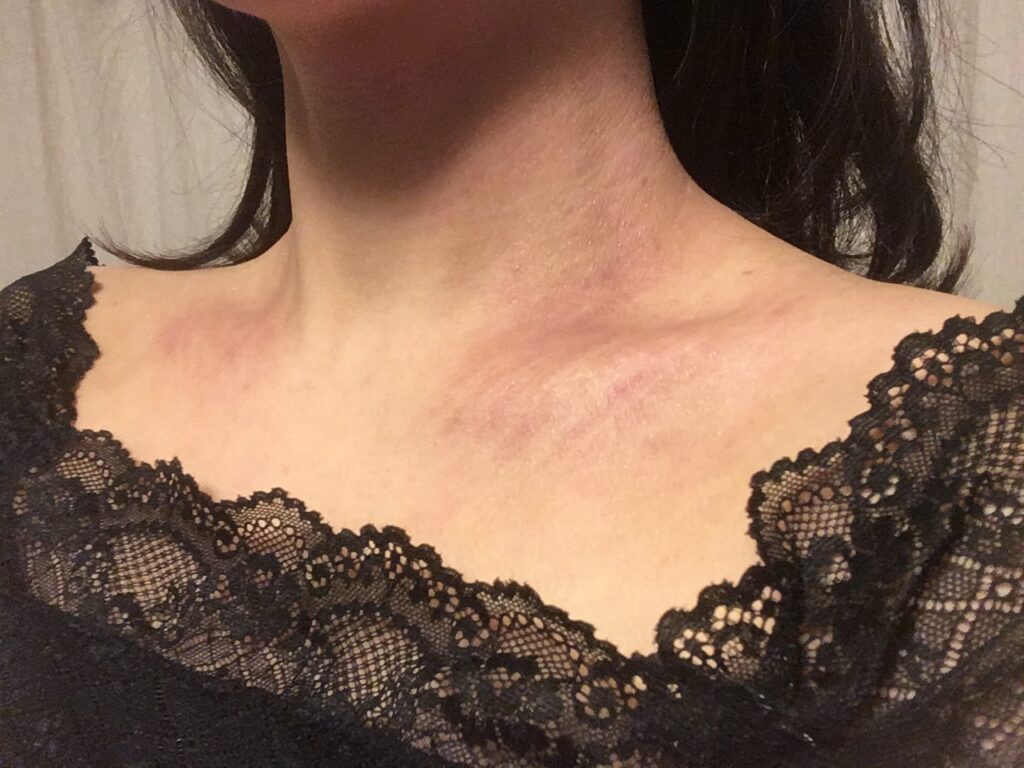 アトピー性皮膚炎が改善した首の写真