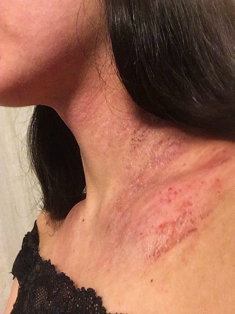 アトピー性皮膚炎で首が爛れている写真